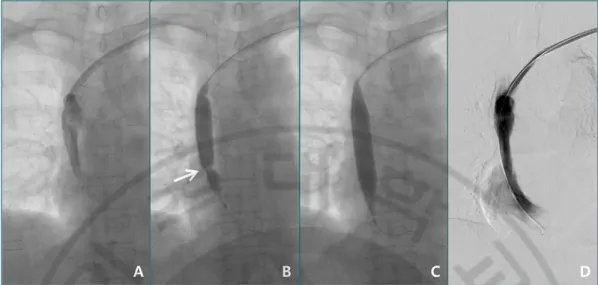 Figure 351-year-old female A. Venography reveals fibrin sheath limiting contrast flow along the  catheter insertion pathway