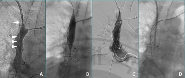 Figure  581-year-old  female  A.  Venography  reveals  complex  findings  of  central  vein  stenosis  at  SVC level (arrow) with fibrin sheath along catheter insertion pathway (arrowheads)
