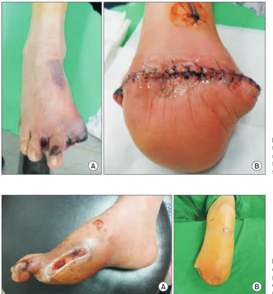 Figure 1. (A) A 59-year-old man had  type II diabetes, amputated toes and skin  necrosis