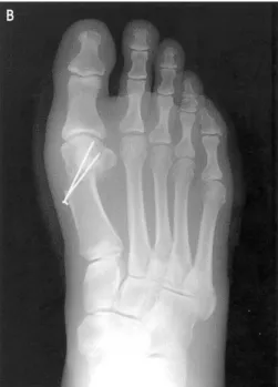Figure  2.  A  45-year-old  woman  with  bilateral  hallux  valgus  deformity,  who  underwent  distal  chevron  osteotomy  with  lateral  soft  tissue  release  of  left  foot  and  distal  chevron  osteotomy  without  lateral  soft  tissue  release  of  