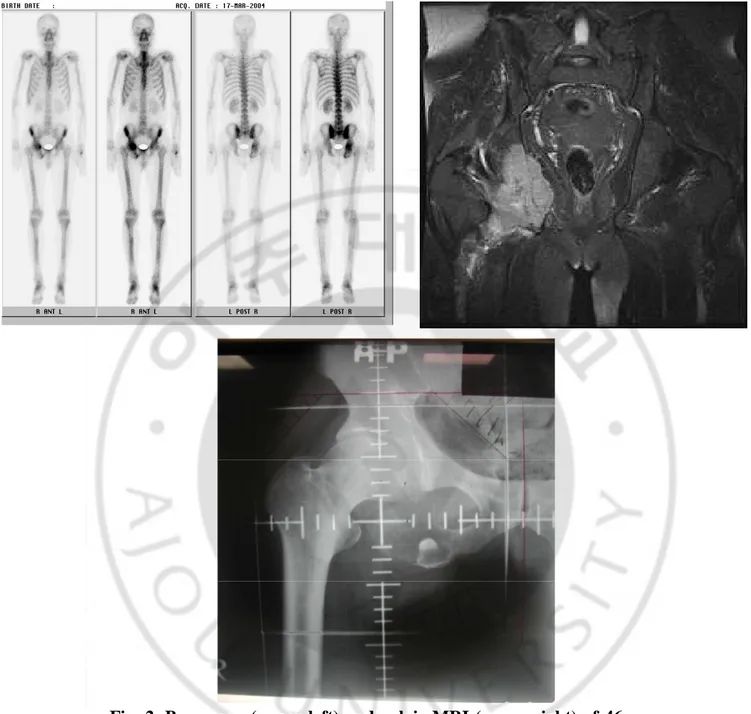 Fig.  2.  Bone  scan  (upper  left)  and  pelvic  MRI  (upper  right)  of  46-year  old  male  patient