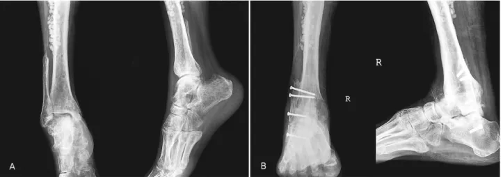 Figure 2. (A)  Preoperative  roentgenogram  of  52  year-old  female  who  had  severe  equinus  deformity  with  persistent  discharge  of  hindfoot