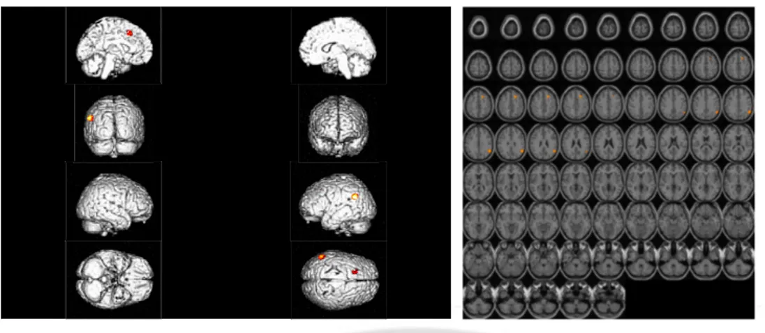 Fig.  1.  Statistical  parametric  maps  showing  the  spatial  distribution  of  significant  metabolic  increase  after  cholinesterase  therapy  in  patients  with  Parkinson’s  disease  dementia