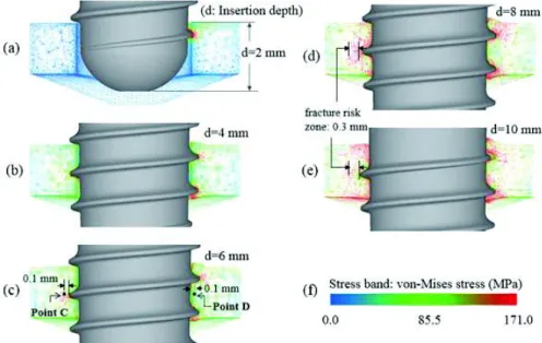 Figure 5.  The von-Mises  stress distributions  in the  mesio-distal  cross-section  of  the  crestal  cortical  bone  during  the  implant  insertion  process;  (a)  at  insertion  depth  d=  2mm,  (b)  d=  4mm,  (c)  d=6mm,  (d)  d=  8mm,  (e)  d=  10mm,