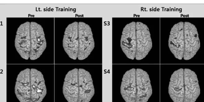 Figure 2. The cortical activation by the serial reaction time task before and after training in each of subjects