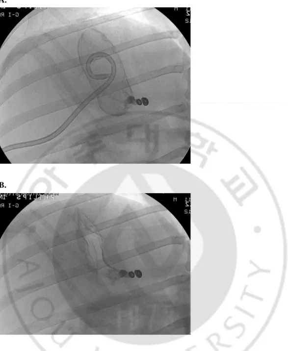 Fig. 2. A spot radiography during and after chemical ablation of the gallbladder. After 
