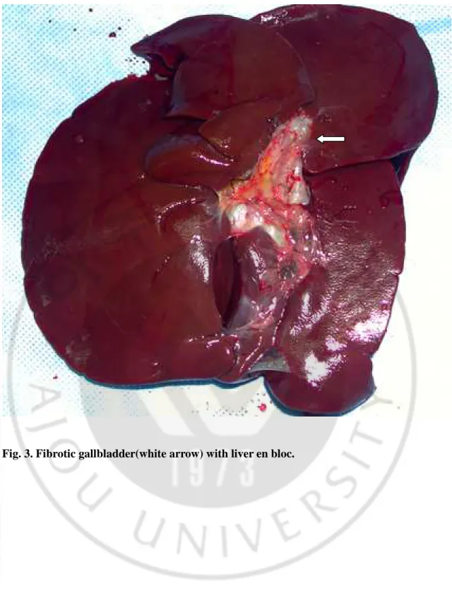 Fig. 3. Fibrotic gallbladder(white arrow) with liver en bloc. 