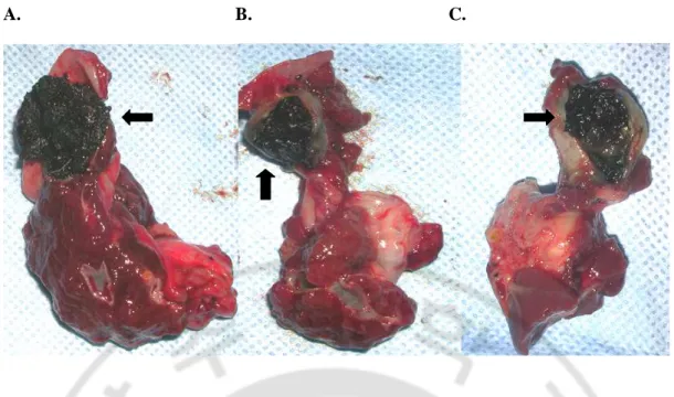 Fig.  4.  Photograph  of  autopsy  specimen  8  weeks  after  gallbladder  ablation.  Fibrosed 