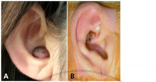 Fig. 2. Gross findings auricular nevi. The dome-like nevus was located in the  cavum concha (case 3 in Table 2, A) and papillomatous nevus was found in the  cymba concha (case 11 in Table 2, B)
