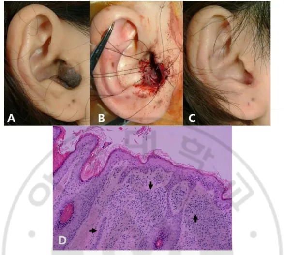 Fig. 3. An auricular nevus (case 4 in Table 2) located on cavum concha.    (A)  preoperative and (B) postoperative findings