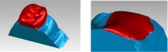Figure 4.  Crown portion removal and automatic filling using arch  curvature