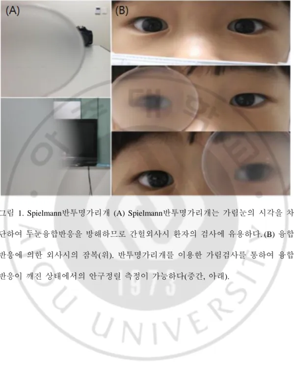그림  1.  Spielmann반투명가리개  (A)  Spielmann반투명가리개는  가림눈의  시각을  차 단하여  두눈융합반응을  방해하므로  간헐외사시  환자의  검사에  유용하다