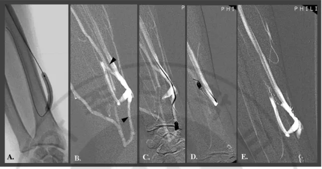 Fig. 2. Endovascular salvage of nonmaturing radiocephalic fistula with persistent  collateral veins after PTA in 41-year-old man