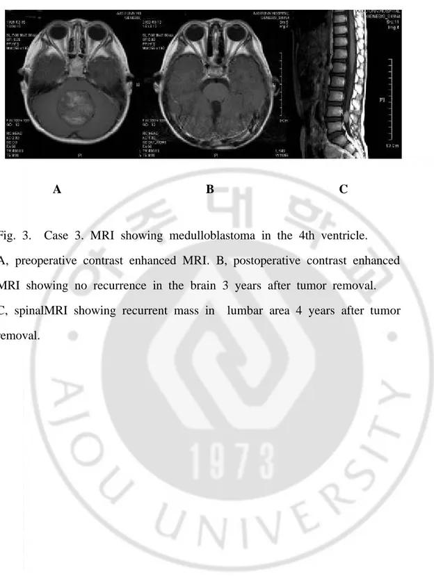 Fig.  3.  Case  3.  MRI  showing  medulloblastoma  in  the  4th  ventricle.
