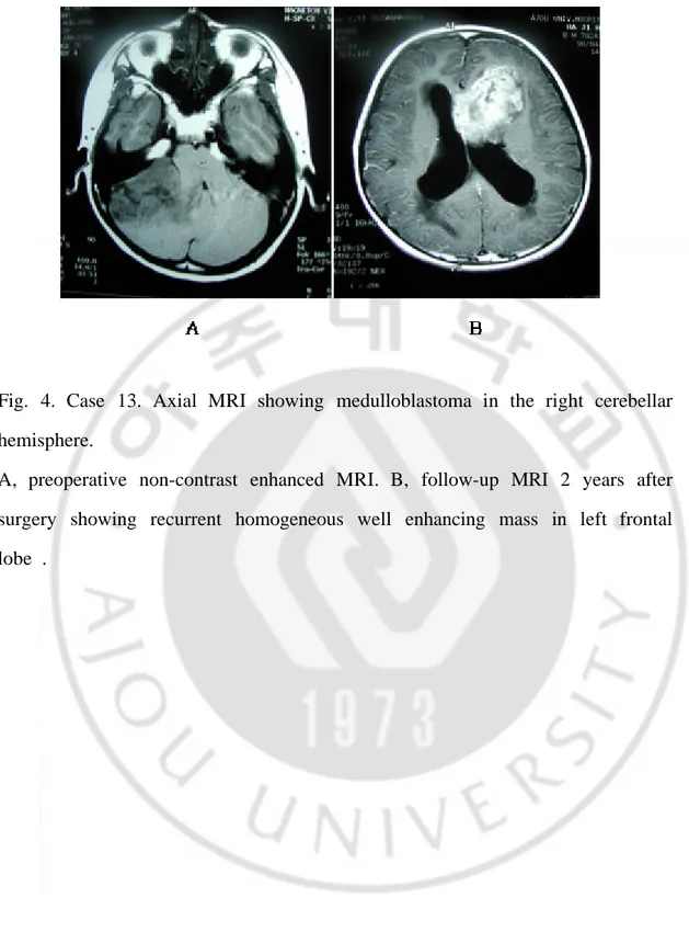 Fig.  4.  Case  13.  Axial  MRI  showing  medulloblastoma  in  the  right  cerebellar  hemisphere.