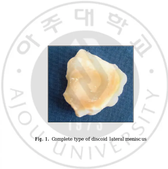 Fig. 1.  Complete type of discoid  lateral menisc us 