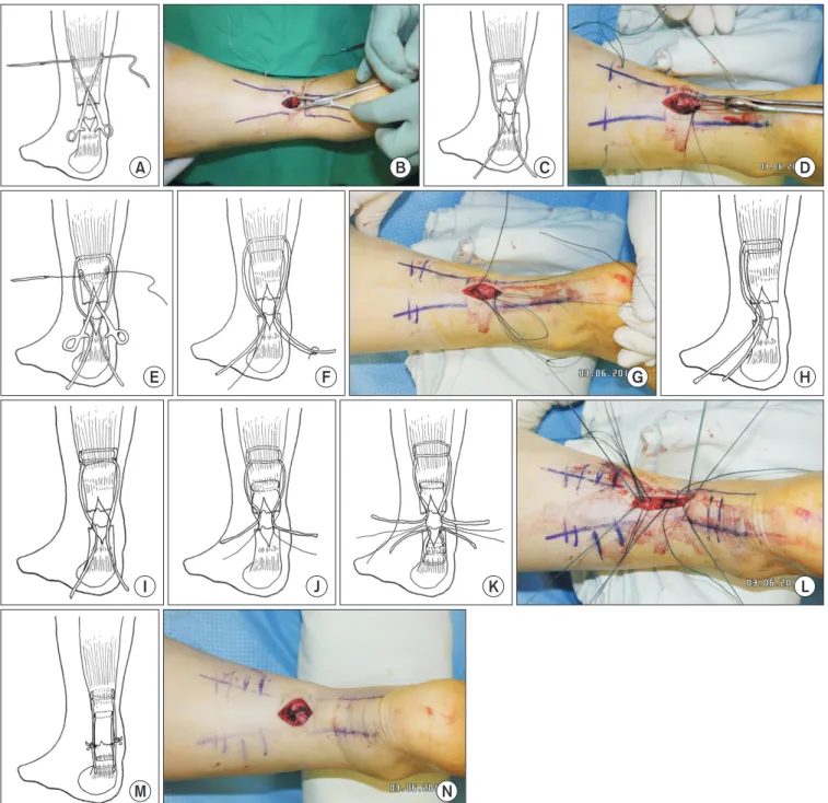 Figure 1. (A, B) Sponge holding forceps are inserted between the tendon and the paratenon to the proximal stump of the tendon and a long straight  needle threaded with a No