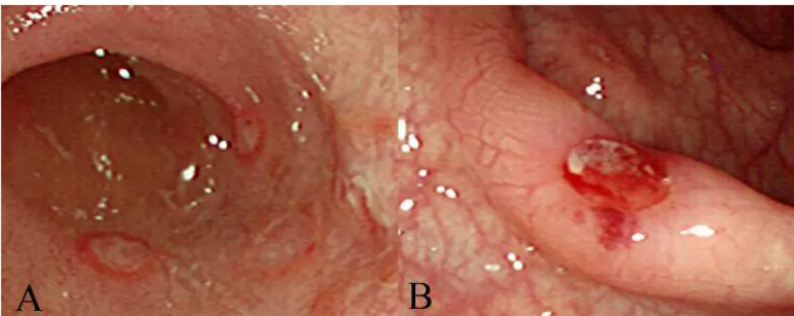 Fig.  2.  Colonoscopic  findings  of  recurrent  aphthous  ulcer  and  intestinal  Behçet’s  disease