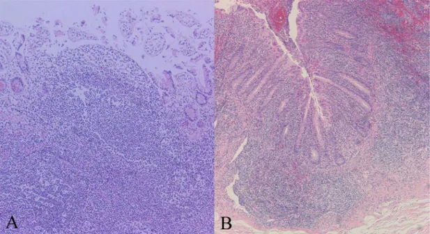Fig. 4. Histopathologic findings of recurrent aphthous ulcer and cecal lesion in Behçet’s  disease