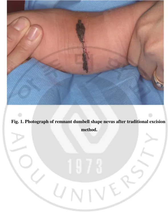 Fig. 1. Photograph of remnant dumbell shape nevus after traditional excision    method