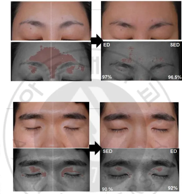 Figure 4. Repigmentation rate using conventional DSLR and UV camera. 