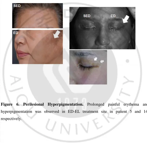Figure  6.  Perilesional  Hyperpigmentation.  Prolonged  painful  erythema  and 