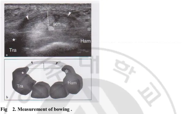 Fig    2. Measurement of bowing .   