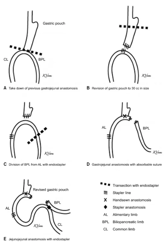 Fig. 2. Laparoscopic conversion of OAGB  to  RYGB.