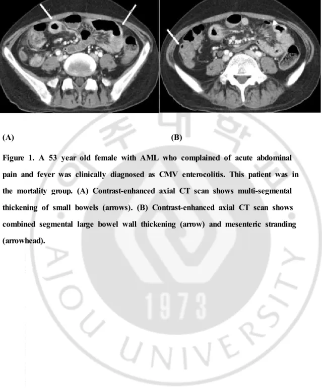 Figure  1.  A  53  year  old  female  with  AML  who  complained  of  acute  abdominal  pain  and  fever  was  clinically  diagnosed  as  CMV  enterocolitis