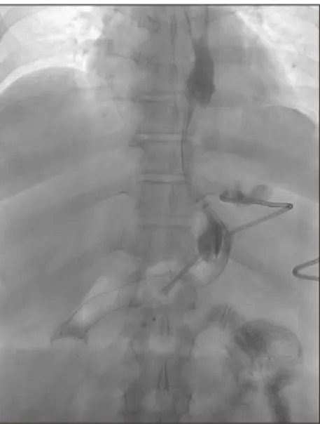 Fig.  1.  Abdominal  X-ray  after  endoscopic  stent  insertion.
