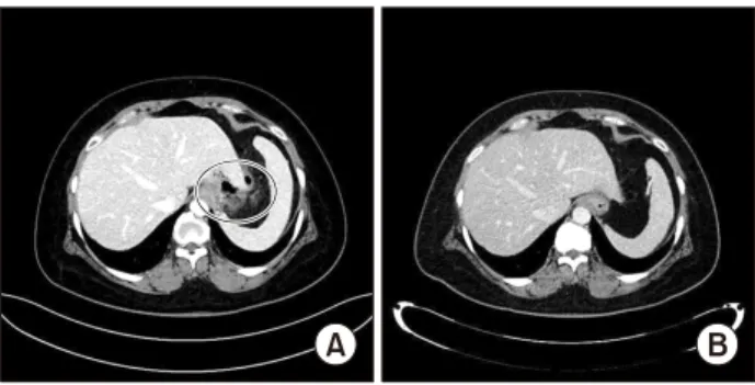 Fig.  2.  Radiologic  findings  before  (A)  and  after  (B)  endoscopic  septotomy.