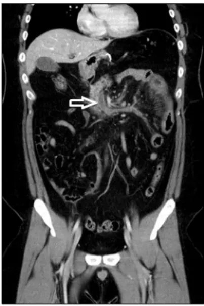 Fig. 1. Computed tomographic image showing Lt and main portal vein  thrombosis  (white  arrow).