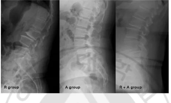 Fig. 2. Radiographs showing the three study groups of degenerative spondylolisthesis  categorised according to the direction of the slip(s)