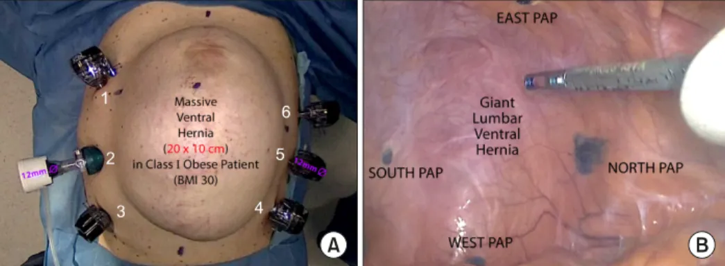 Fig.  1.  “Slim-Mesh”  (SM)  technique  PHASE  1  (see  SM  YouTube  video):  First  laparoscopic  step:  (A)  Size,  location,  and  total  count  (3-  or 6) for  ports  for  operation  using  a  giant/massive  (GM)  SM