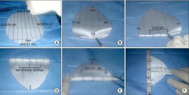 Fig. 2. PHASE 2: Marking corresponding skin axial points (SAP)  and measurement of skin (external) SMAA, which is the same as the  peritoneal  or  internal  SMAA.