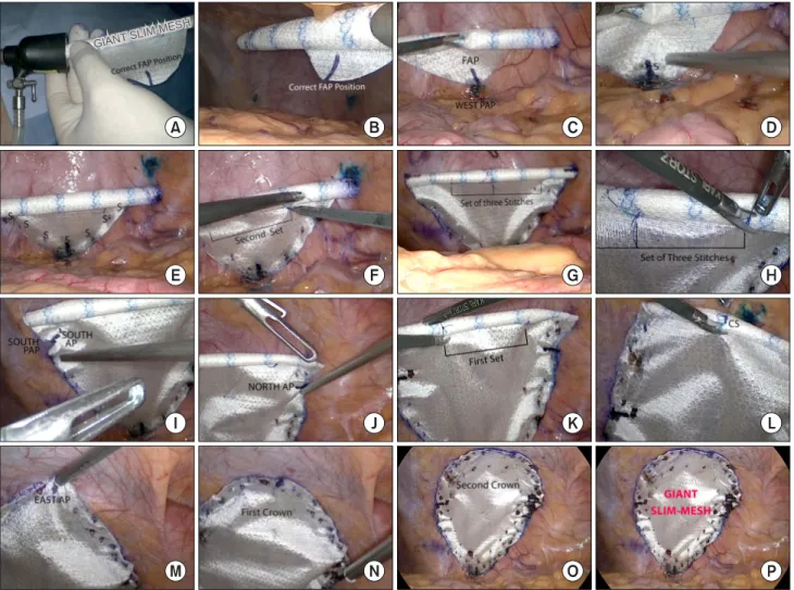 Fig.  4.  PHASE  4:  Last  laparoscopic  step:  (A)  12-mm  port  SM  introduction  with  correct  FAP  position