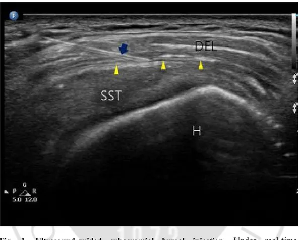 Fig.  1.  Ultrasound-guided  subacromial  bursal  injection.  Under  real-time  ultrasonographic guidance, a 21 gauge needle (blue arrow) is inserted within the  subacromial  subdeltoid  bursa  (yellow  arrowheads)