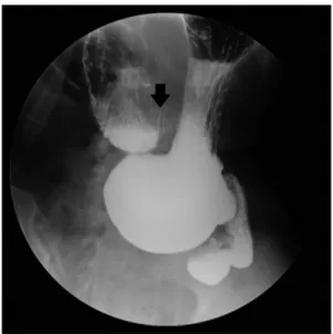 Fig.  1.  (A)  Coronal  image  of  com- com-puted  tomography  showed  gastric  distension  and  normal  position  of  gastric  band