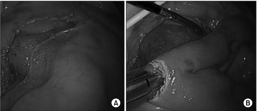 Fig.  3.  (A)  Second  and  third  portion of  duodenum  was  exposed  by  division  of  mesocolon
