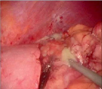 Fig.  6.  Intra-operative  collection  around  leak  site.