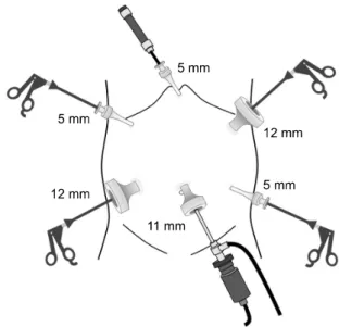 Fig.  1.  Position  of  the  trocars  in  laparoscopic  mini-gastric  bypass.