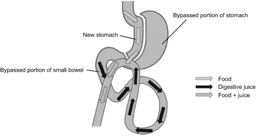 Fig.  2.  Schematic  diagram  of  the  laparoscopic  mini-gastric  bypass  procedure.