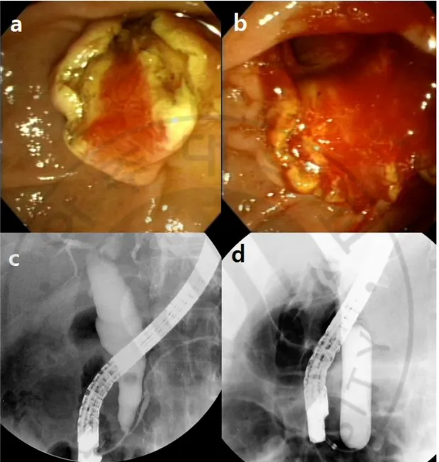 Fig.  1.  Endoscopic  and  cholangiographic  images  from  case  1  (see  Table  4).  (a,  b)  Endoscopic images before and after the balloon inflation in case 1