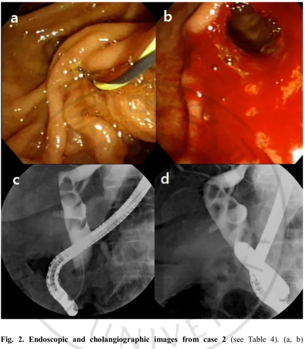 Fig.  2.  Endoscopic  and  cholangiographic  images  from  case  2  (see  Table  4).  (a,  b)  Endoscopic images before and after the balloon inflation in case 2