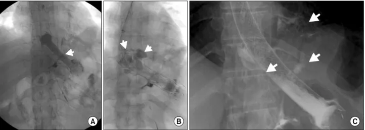 Fig.  2.  (A)  Inserted  stent.  (B)  Dislocated  stents  and  persistent  leakage.  (C)  Persistent  leakage.