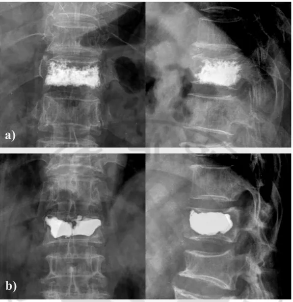 Fig. 2. Different bone cement distributions. a) Spongy shape after vertebroplasty with 