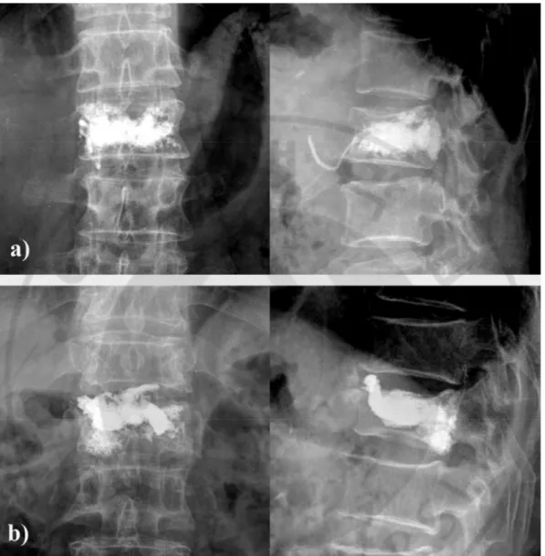 Fig. 3. Bone cement leakage after procedure. a) Venous leakage after vertebroplasty with 