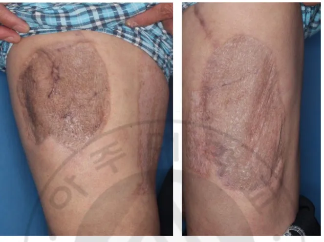 Figure 1. Two donor sites of the anterolateral thigh flap. Left: skin graft only, Right: skin graft with 