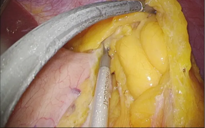 Fig.  1.  Division  of  the  greater  omentum  up  to  the  angle  of  His.