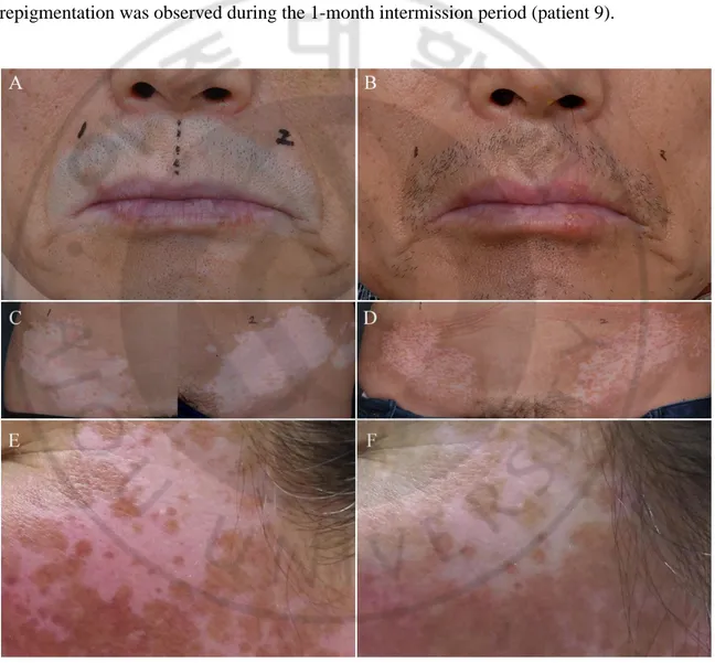 Fig.  1.  Repigmentation  of  vitiligo  after  continuous  and  cyclic  excimer  laser  treatments